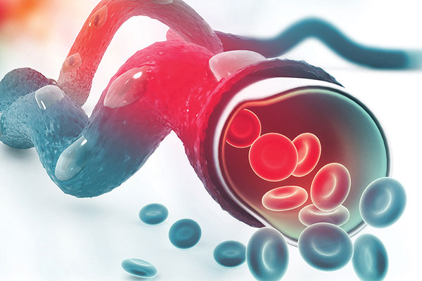Female Sex as a Risk Factor for Ischemic Stro